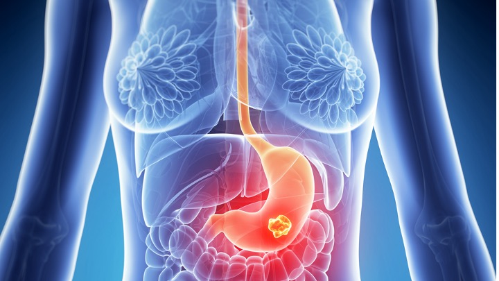 Cánceres gástricos y de la unión gastroesofágica: Durvalumab + QT mejoró la pCR, estudio MATTERHORN