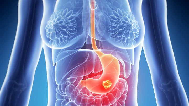 Ca. gástrico/unión gastroesofágica HER2+: Eficacia clínicamente significativa con trastuzumab deruxtecan, estudio DESTINY-Gastric02