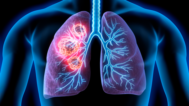 CPCNP EGFRm: Amivantamab + QT cumplen objetivo primario, estudio PAPILLON
