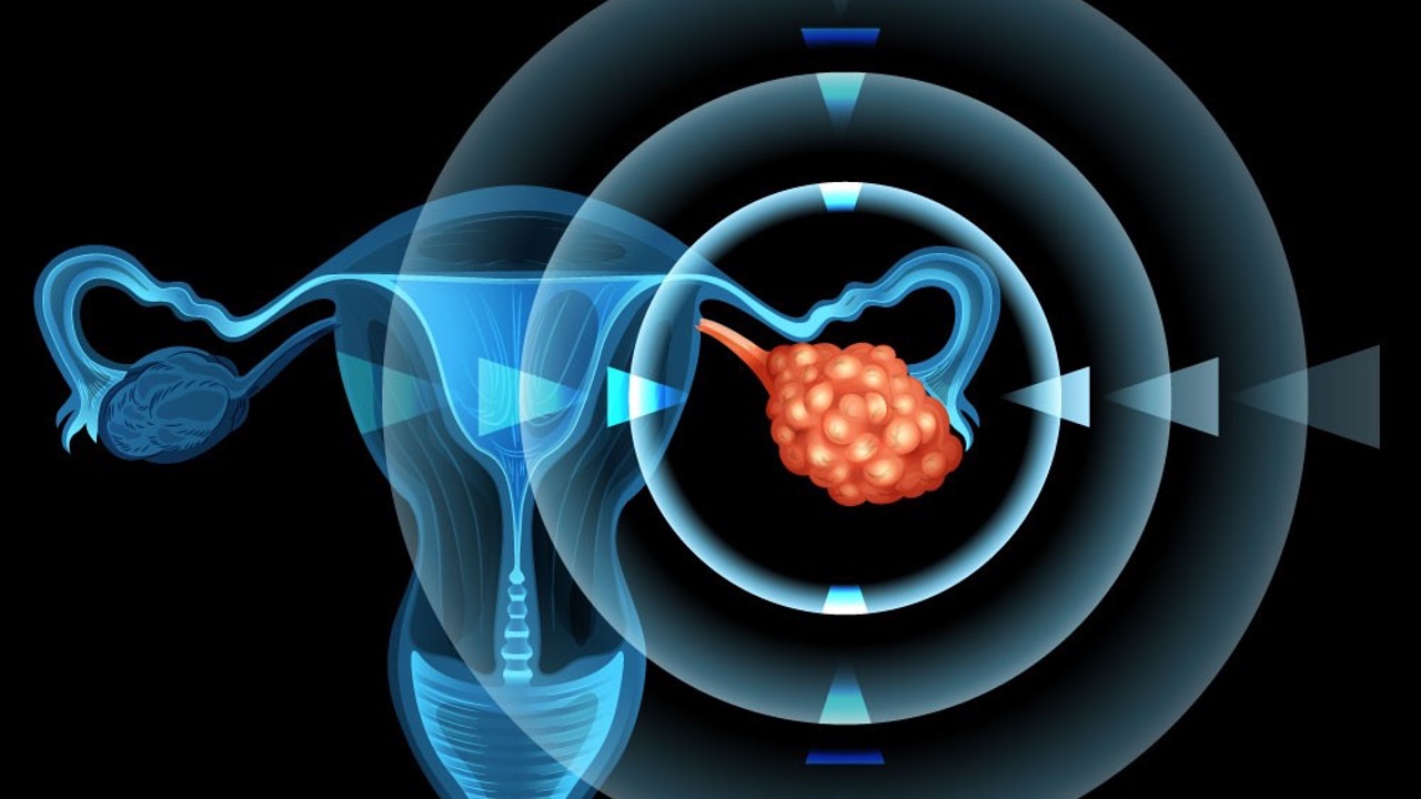 Cá. de ovario platino resistente: TTFields no alcanza SG en estudio ENGOT-ov50/GOG-3029/INNOVATE-3