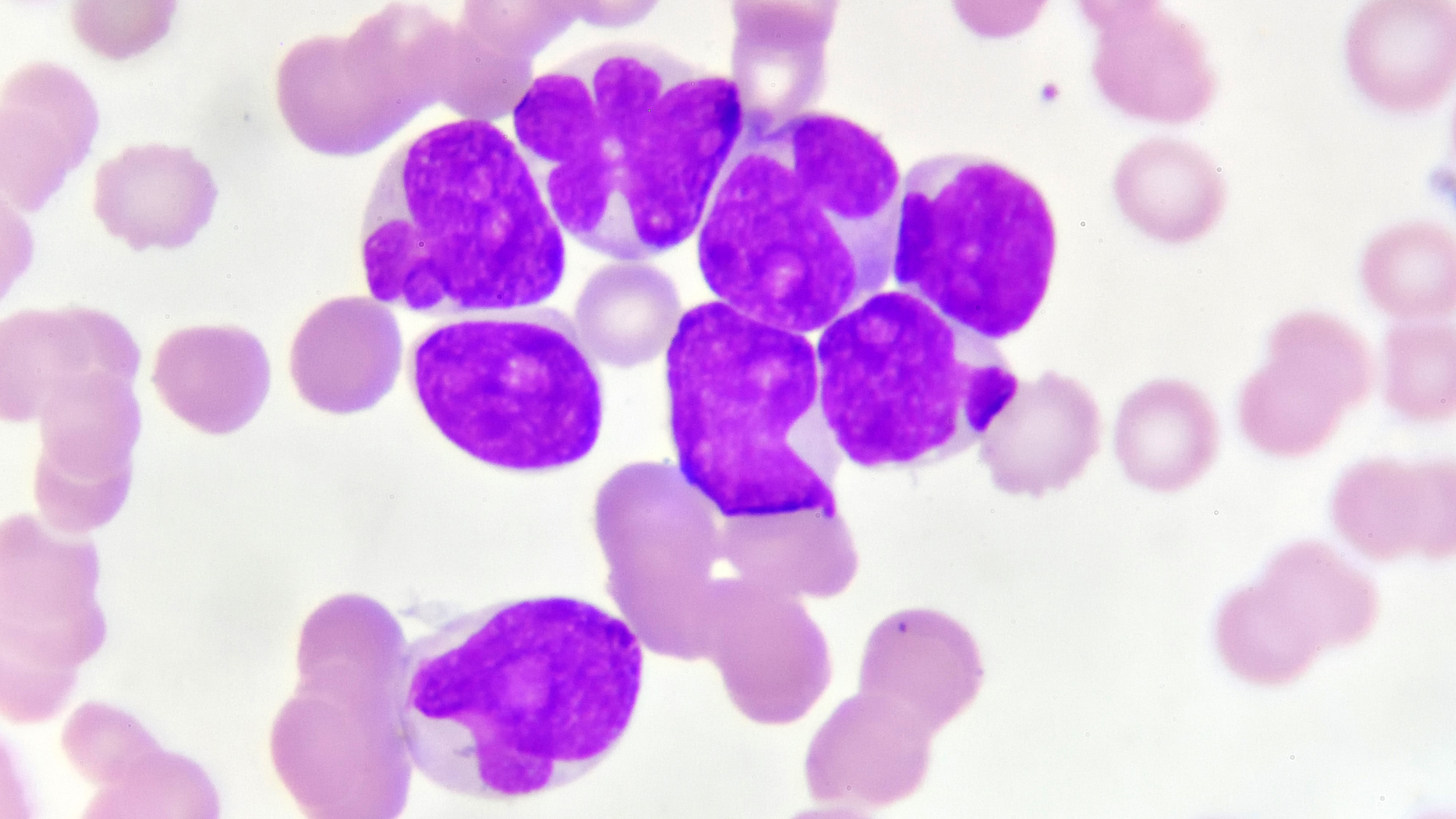 LMA: suspensión del estudio ENHANCE-2 con magrolimab