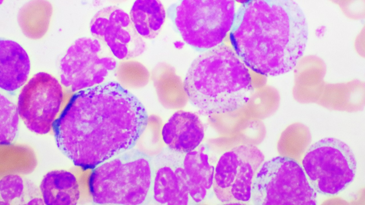 LMC: la FDA aprueba bosutinib para algunos pacientes pediátricos, estudio BCHILD