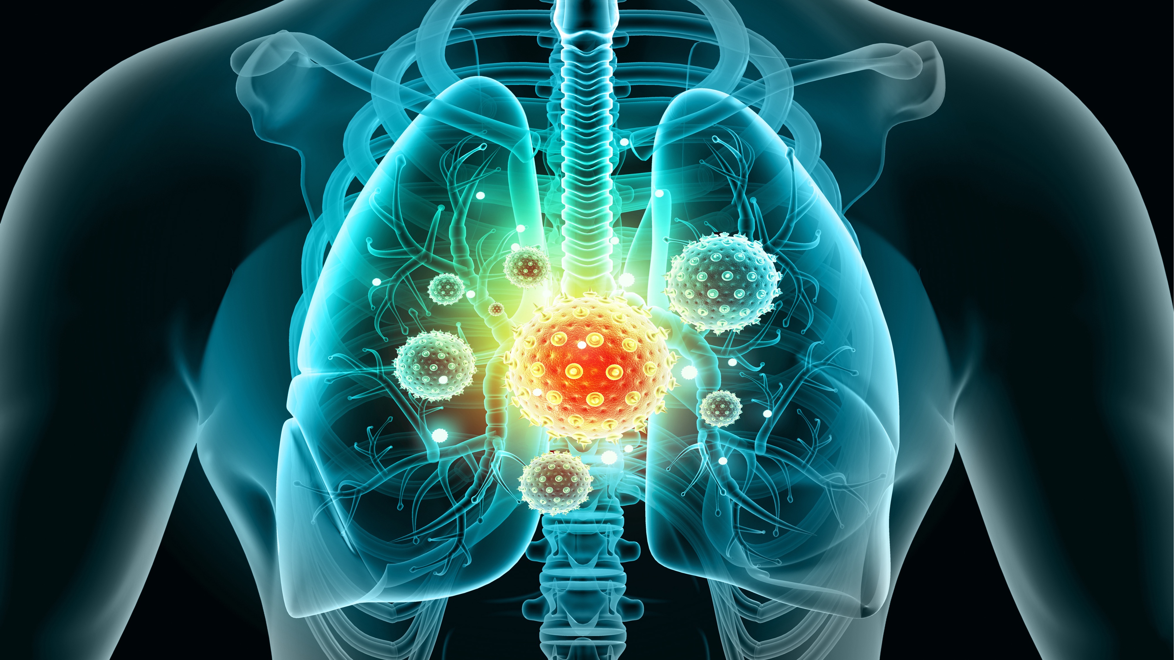 CPCNP: la combinación de durvalumab perioperatorio y QT neoadyuvante no tuvo un impacto adverso en la cirugía, estudio AEGEAN
