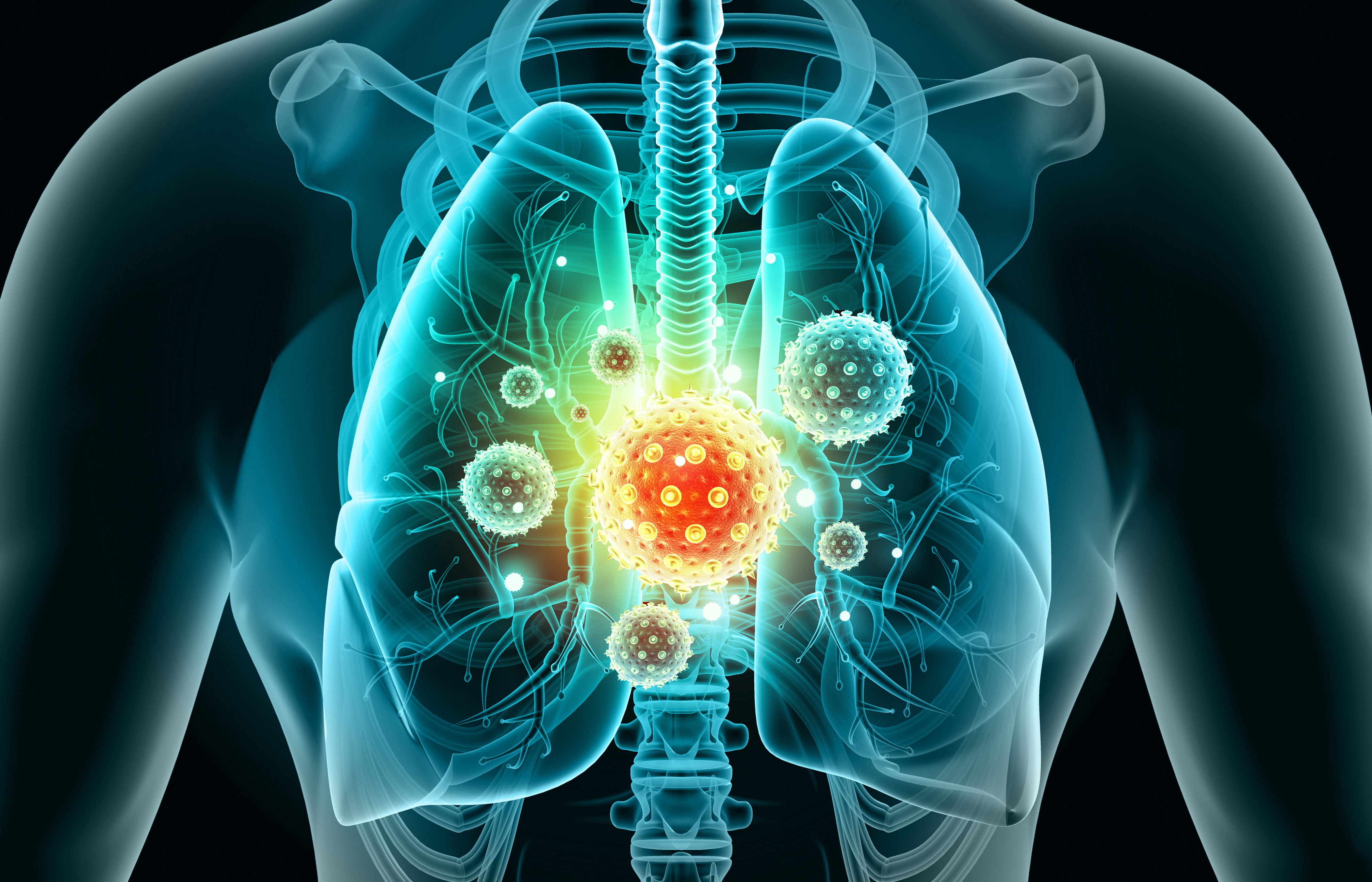 CPCNP: el régimen perioperatorio de nivolumab + QT en neoadyuvancia mejoró significativamente la SLE