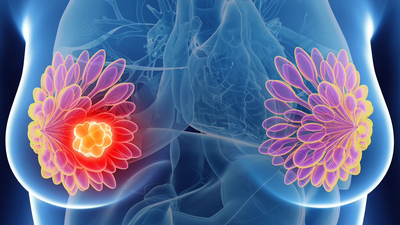 Cáncer de mama RH+/HER2-: la FDA aprueba capivasertib + fulvestrant, estudio CAPItello-291