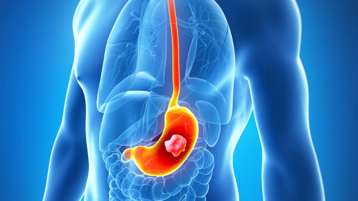 Adenocarcinoma gástrico o de la unión gastroesofágica HER2-: FDA aprobó pembrolizumab con QT como tratamiento de primera línea