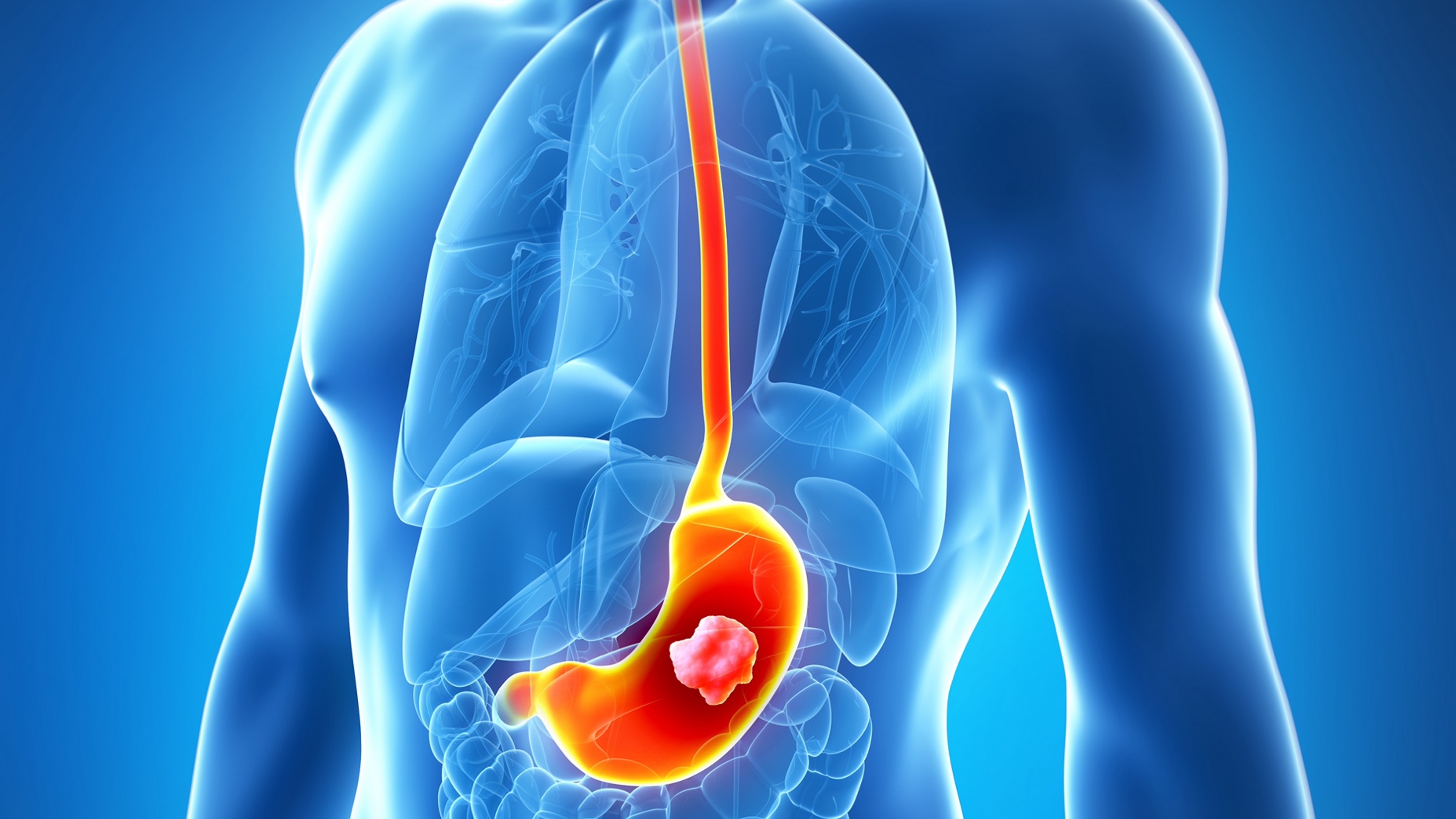 Adenocarcinoma gastroesofágico avanzado: nivolumab más QT continúan demostrando beneficio en supervivencia, seguimiento CheckMate-649