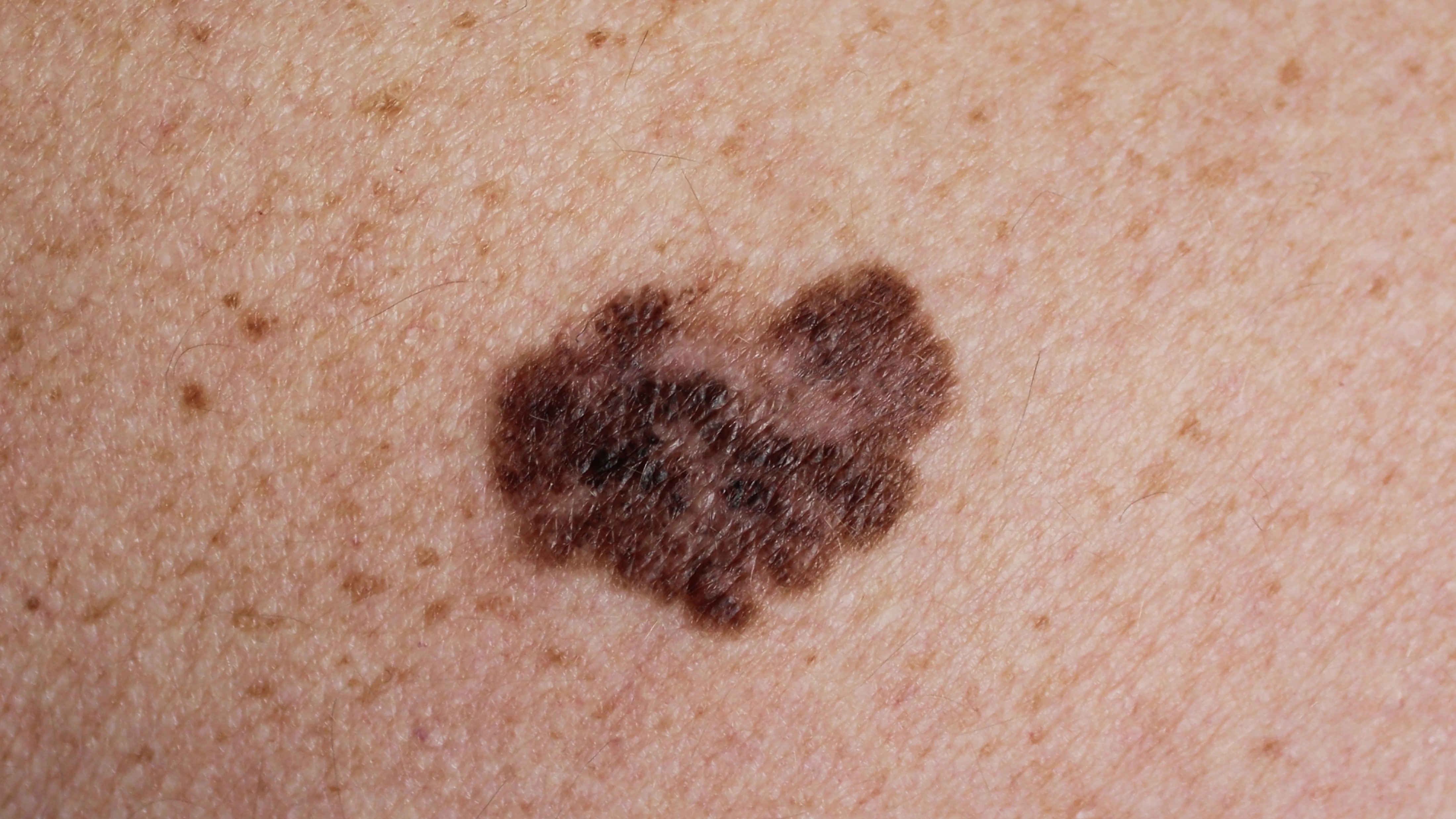 Melanoma inoperable o metastásico: la FDA aprueba lifileucel