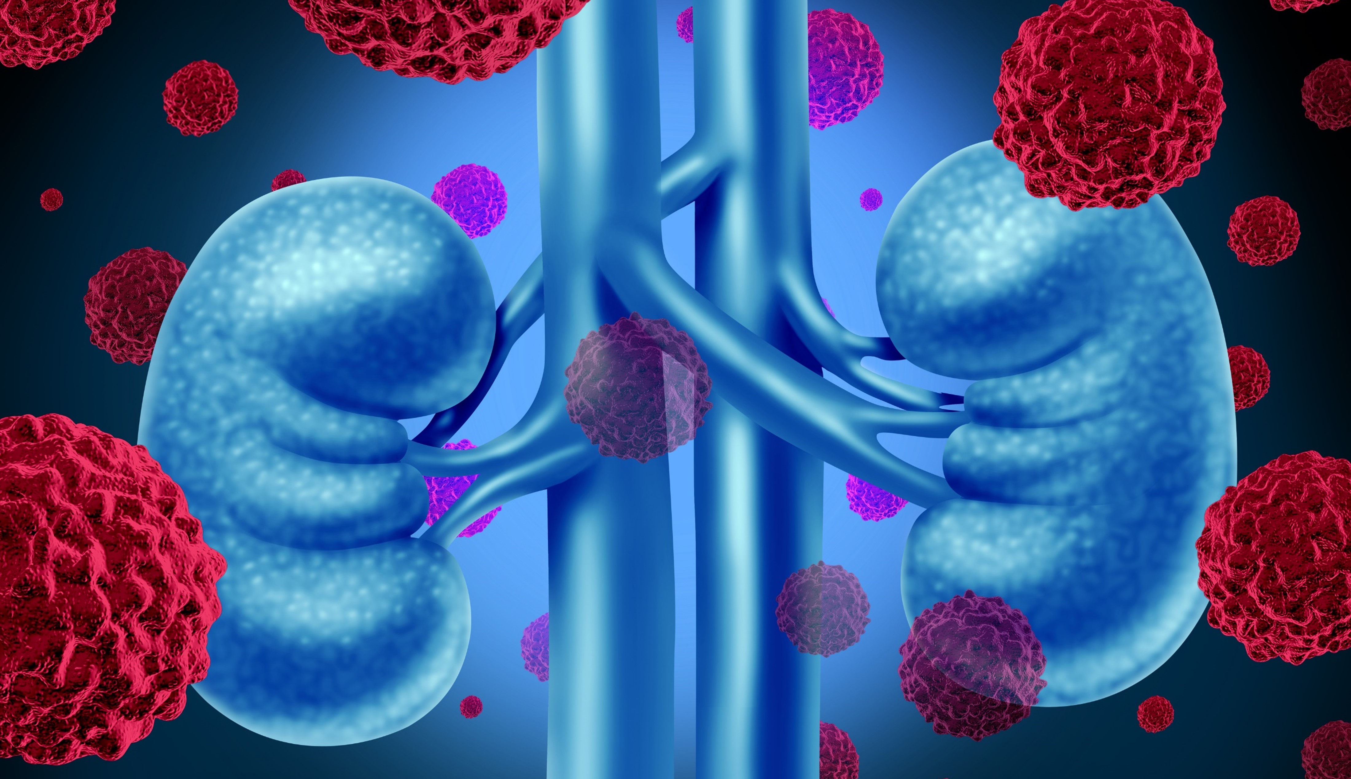 CCRccm: se recomienda el uso de nivolumab + ipilimumab vs. cabozantinib + nivolumab + ipilimumab, guías de tratamiento