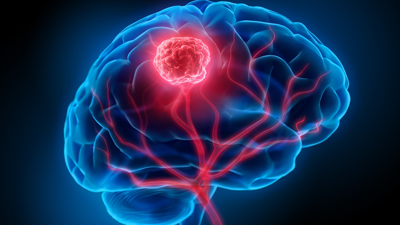 Glioma pediátrico de bajo grado R/R: FDA aprueba tovorafenib, estudio FIREFLY-1
