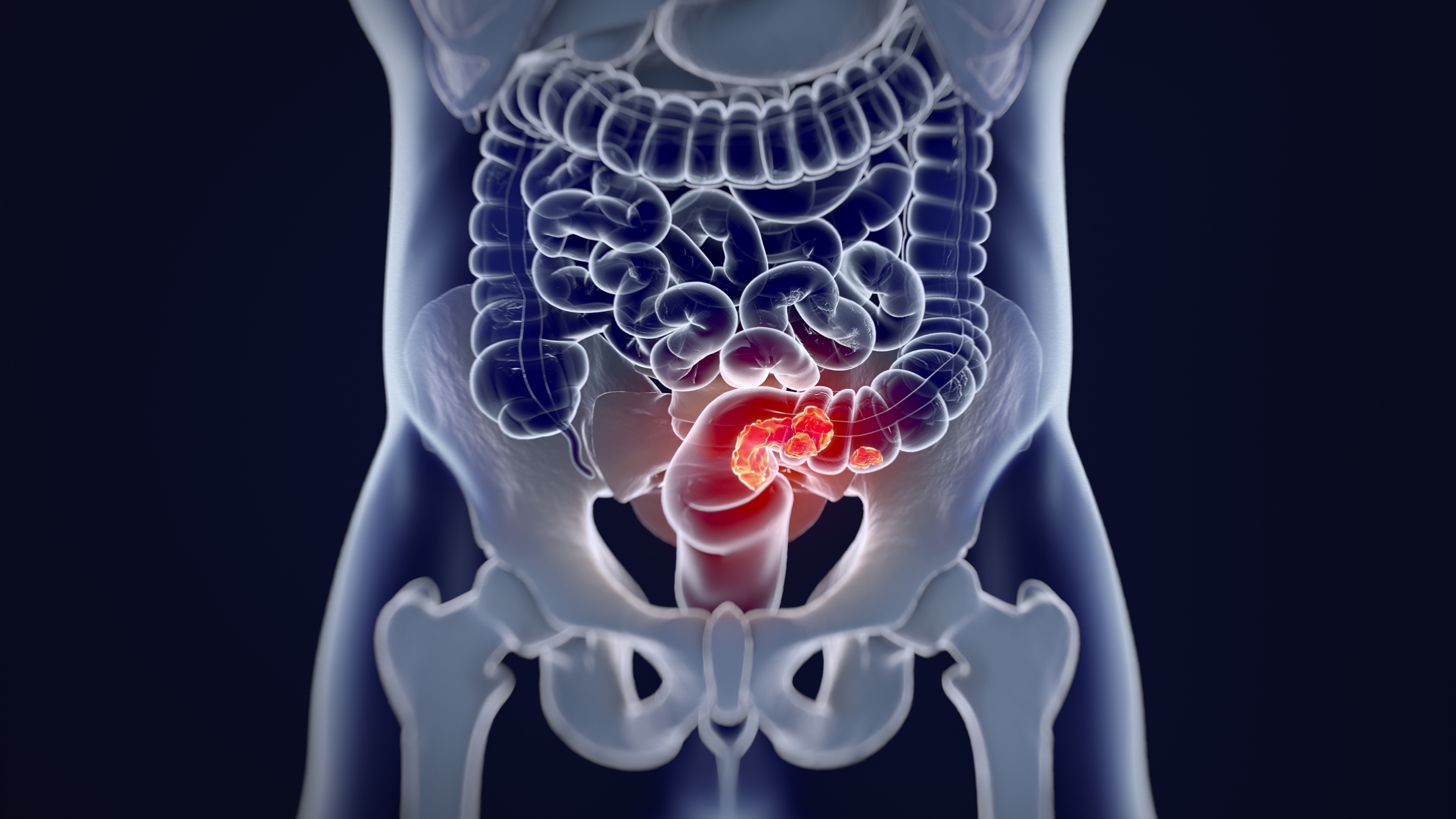 CCR: FDA aprobó prueba de detección no invasiva, estudio CRC-PREVENT