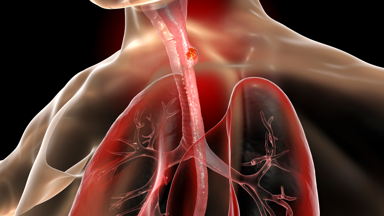 Carcinoma escamoso de esófago localmente avanzado e inoperable: capecitabina o capecitabina + oxaliplatino no mejoraron significativamente la tasa de SG en comparación con fluorouracilo más cisplatino