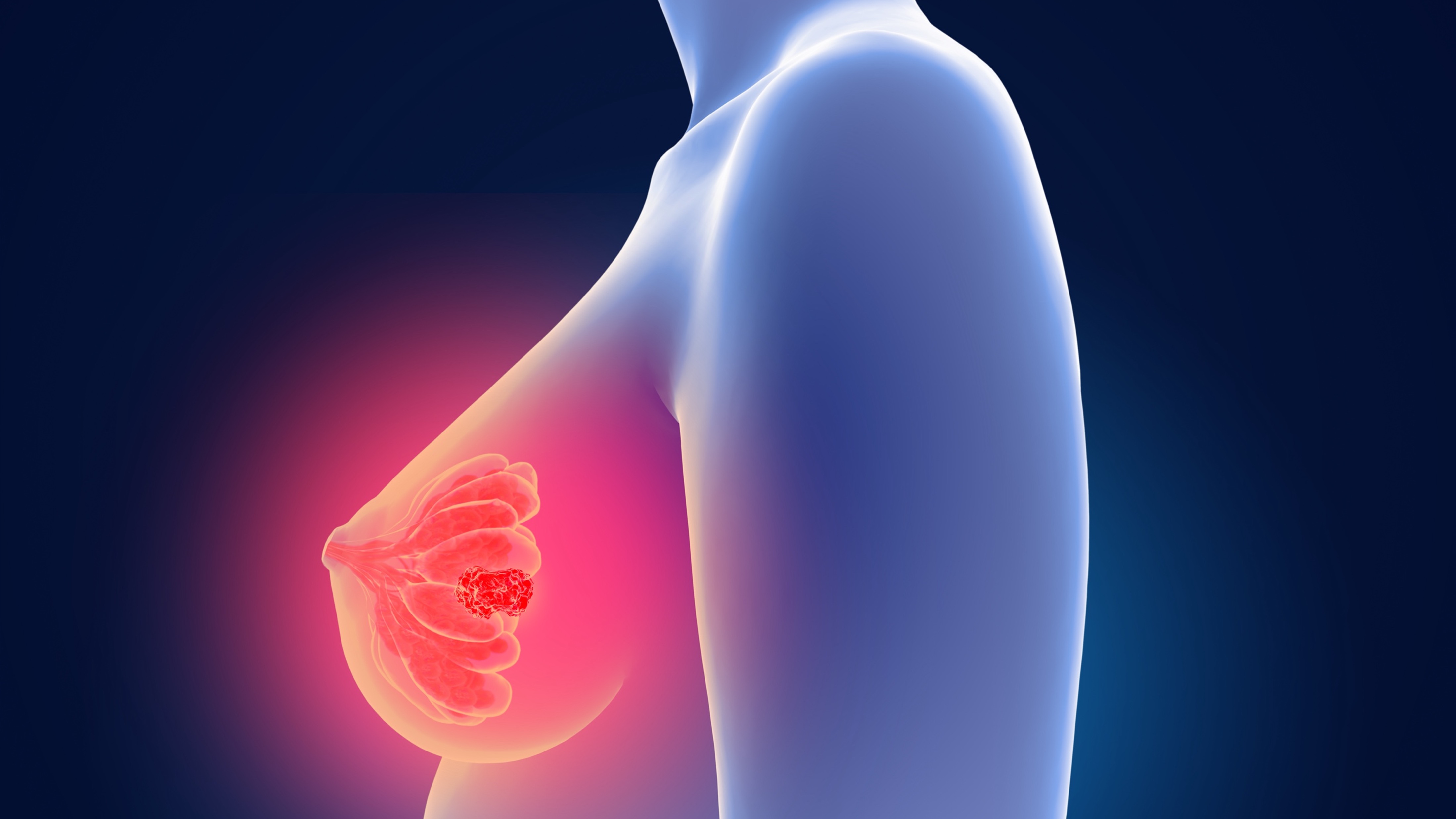 CMTN en etapa temprana y de alto riesgo: pembrolizumab logra su objetivo primario de SG en el estudio KEYNOTE-522