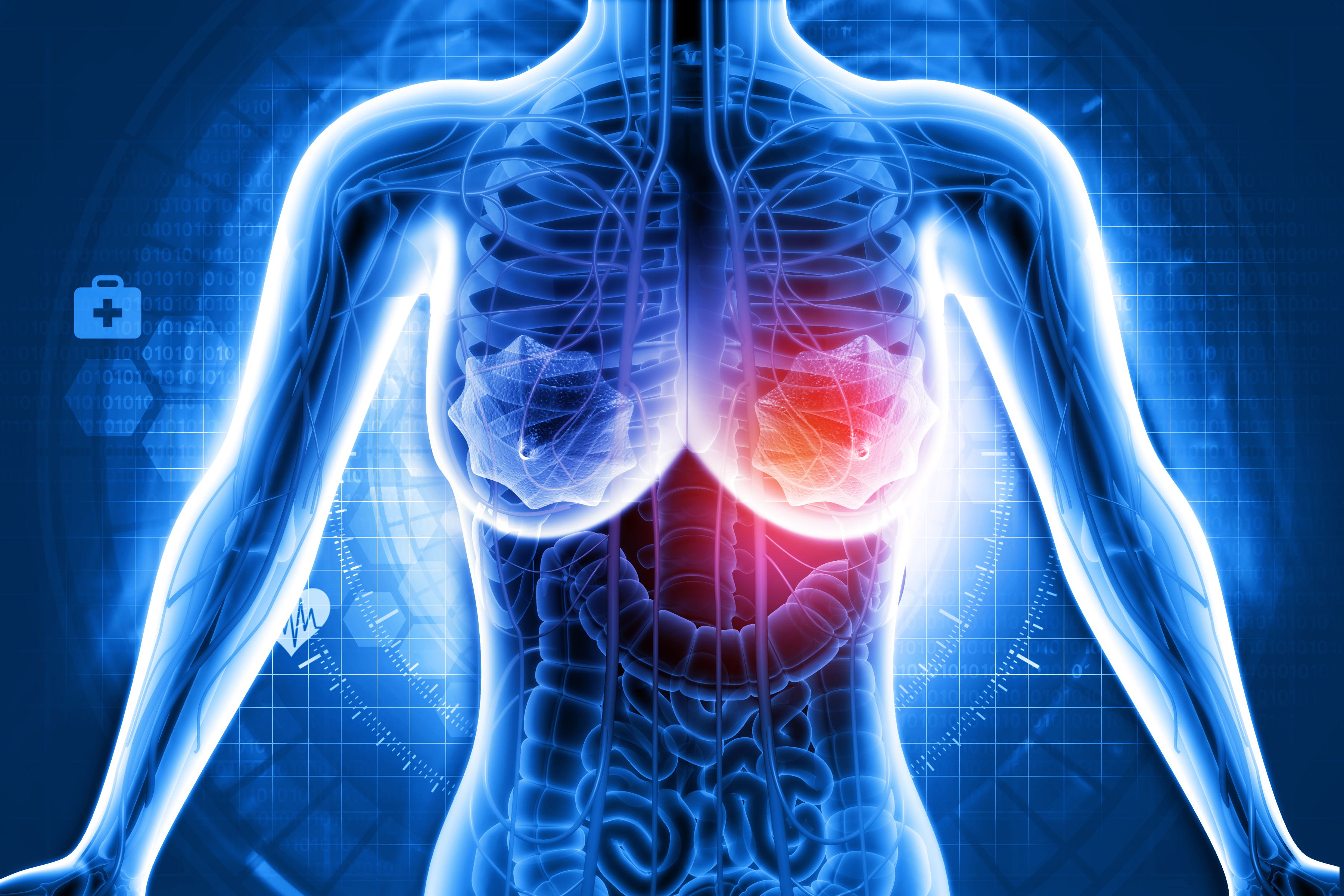 Cá. de mama temprano HER2+: atezolizumab mejora la SLE a 3 años, estudio IMpassion050