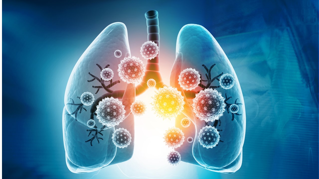 CPCNP no escamoso avanzado: Dato-DXd no alcanzó significancia estadística en la SG vs. docetaxel, estudio TROPION-Lung01