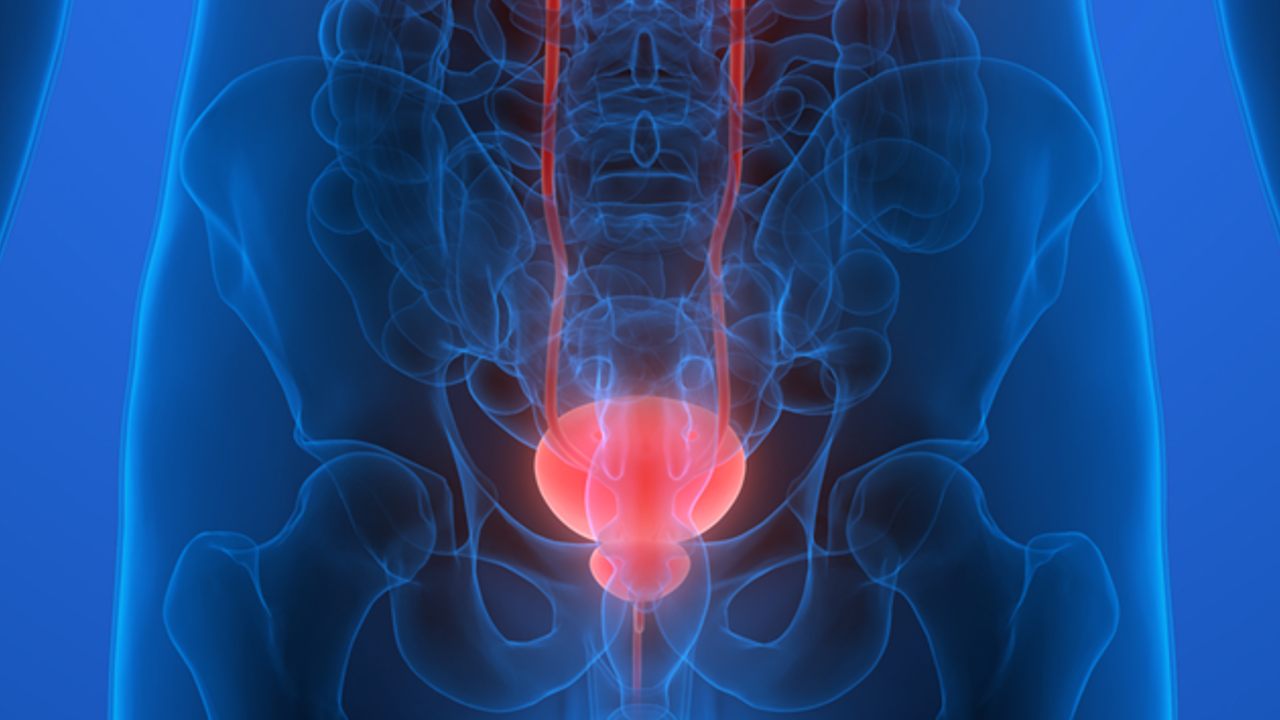 Cá. urotelial de tracto superior: UGN-101 como terapia de mantenimiento demuestra una buena durabilidad de la respuesta