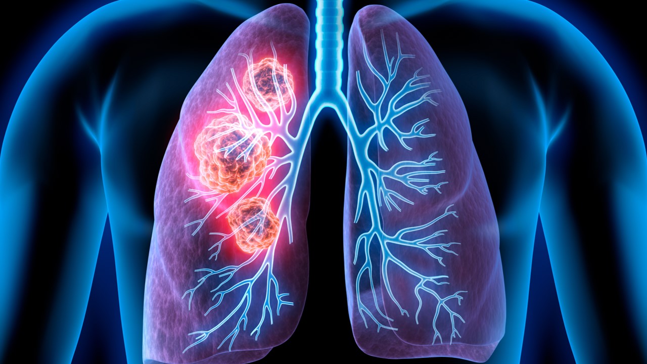 CPCNP avanzado EGFRm: amivantamab + QT prolongaron la SLP, estudio MARIPOSA-2