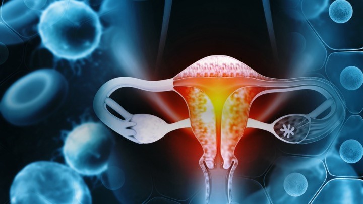 Cá. de endometrio avanzado: lenvatinib/pembrolizumab no cumplen con los objetivos finales de SG, ENGOT-en9/LEAP-001