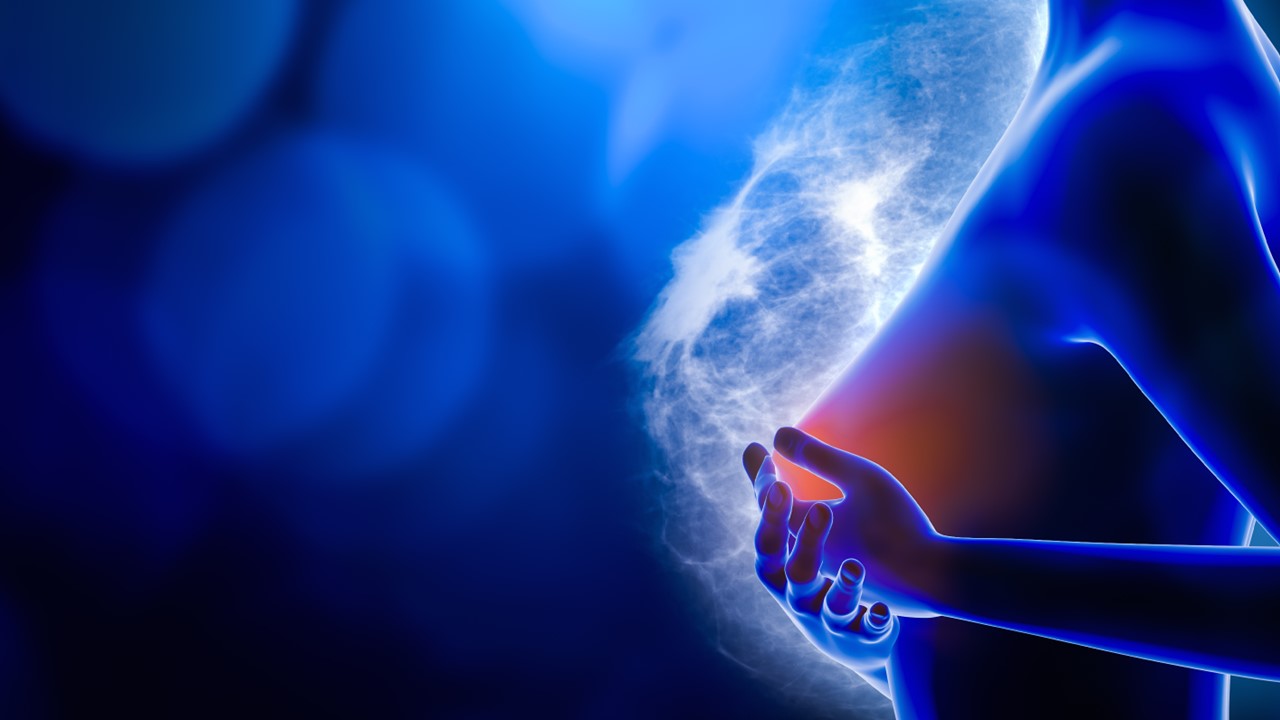 CMTN temprano: atezolizumab + QT no mejoraron significativamente la SG vs. placebo, estudio IMpassion132