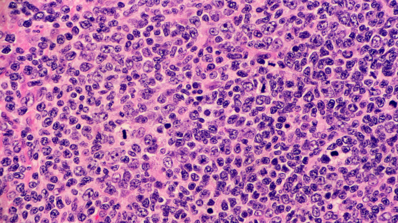 LF R/R: tafasitamab cumplió con su objetivo primario de SLP, estudio inMIND