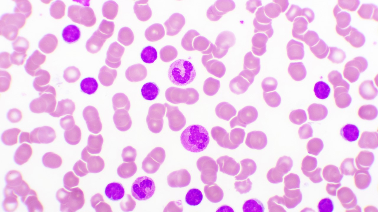 LLA-B R/R: blinatumomab e inotuzumab ozogamicina supera a la QT, según estudios presentados en SOHO 2024