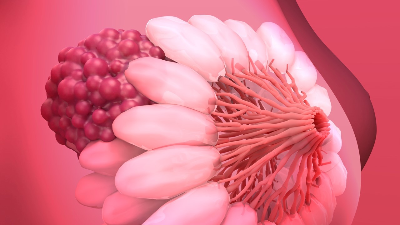 Cá. de mama RH+/HER2-negativo de alto riesgo: la FDA aprueba ribociclib con IA como tratamiento adyuvante