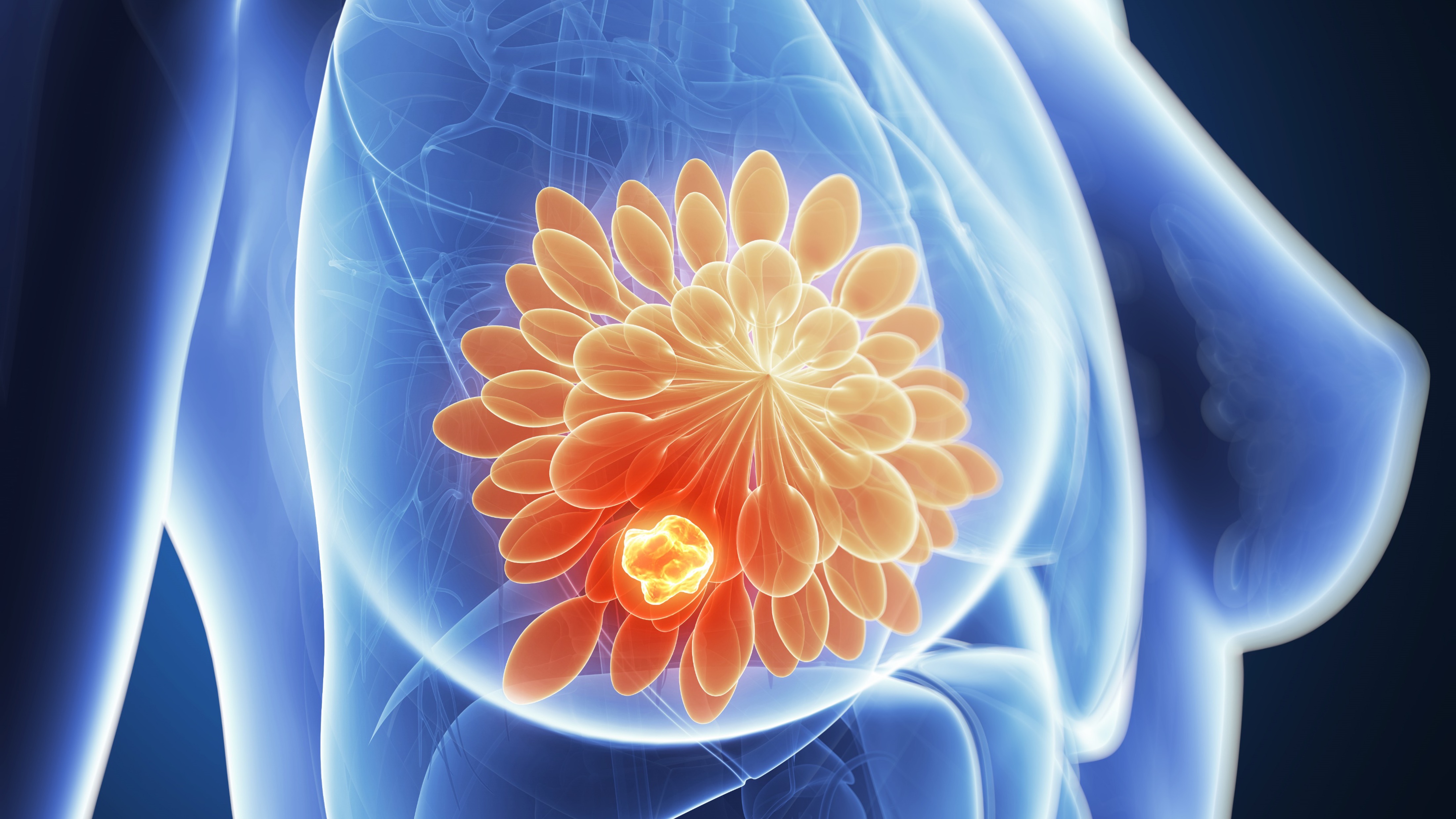 CMm RH+/HER2-bajo o negativo: datos finales de SG de Dato-DXd, estudio TROPION-Breast01