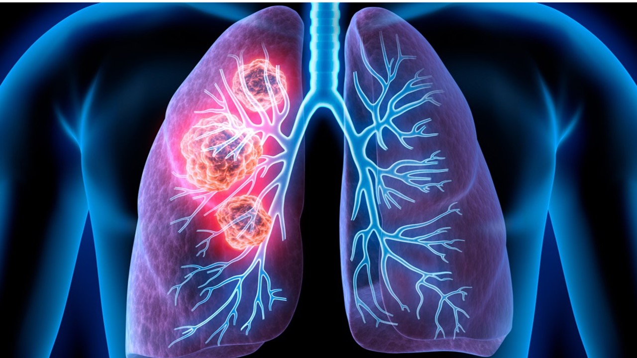 CPCNPm: aprobación de un dispositivo médico portátil por la FDA que utiliza TTFields