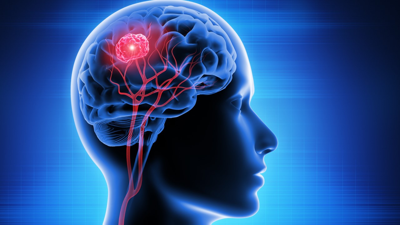 Astrocitoma u oligodendroglioma: FDA aprueba prueba Oncomine Dx para identificar pacientes con glioma de grado 2 y mutaciones en IDH 1 o IDH 2