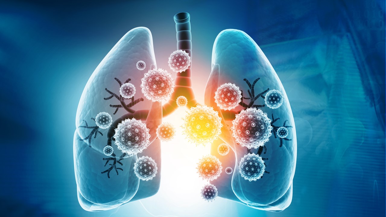 CPCNP resecable sin mutaciones EGFR o ALK: la FDA aprueba nivolumab como tratamiento neoadyuvante/adyuvante con QT doble basada en platino, estudio CheckMate-77T