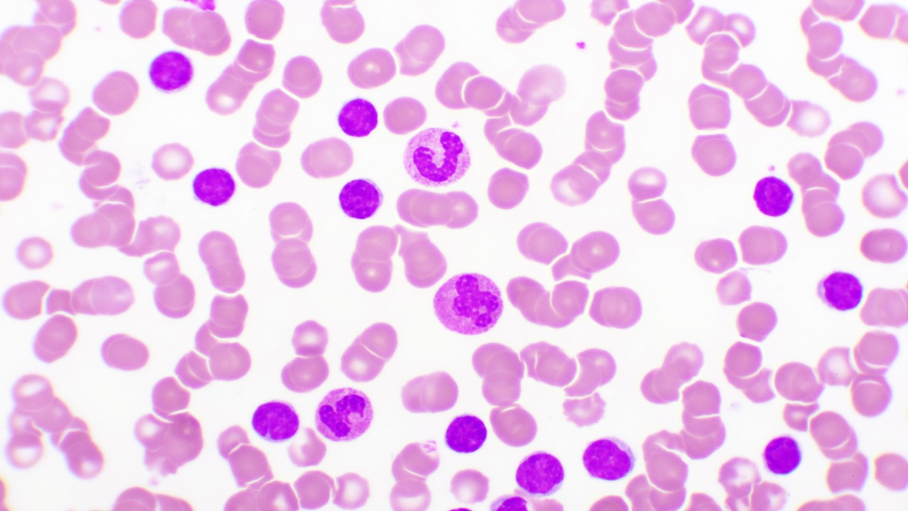 LLA de células-B R/R: la FDA aprueba obecabtagene autoleucel, estudio FELIX
