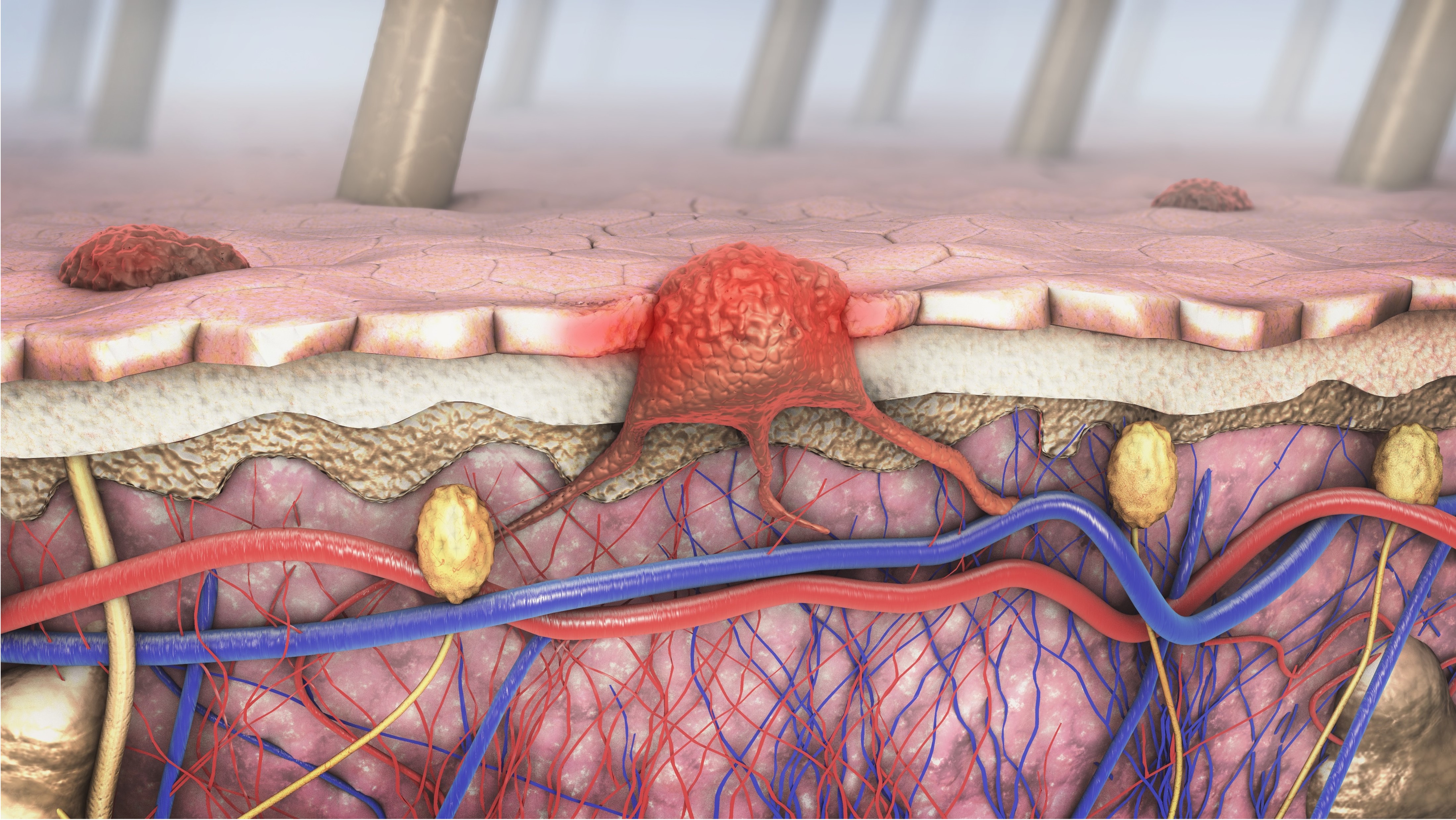 Carcinoma cutáneo de células escamosas metastásico o localmente avanzado: la FDA aprueba cosibelimab