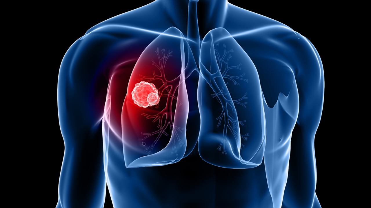 CPCNP localmente avanzado o metastásico con ALK positivo: la FDA aprueba ensartinib, estudio eXalt3