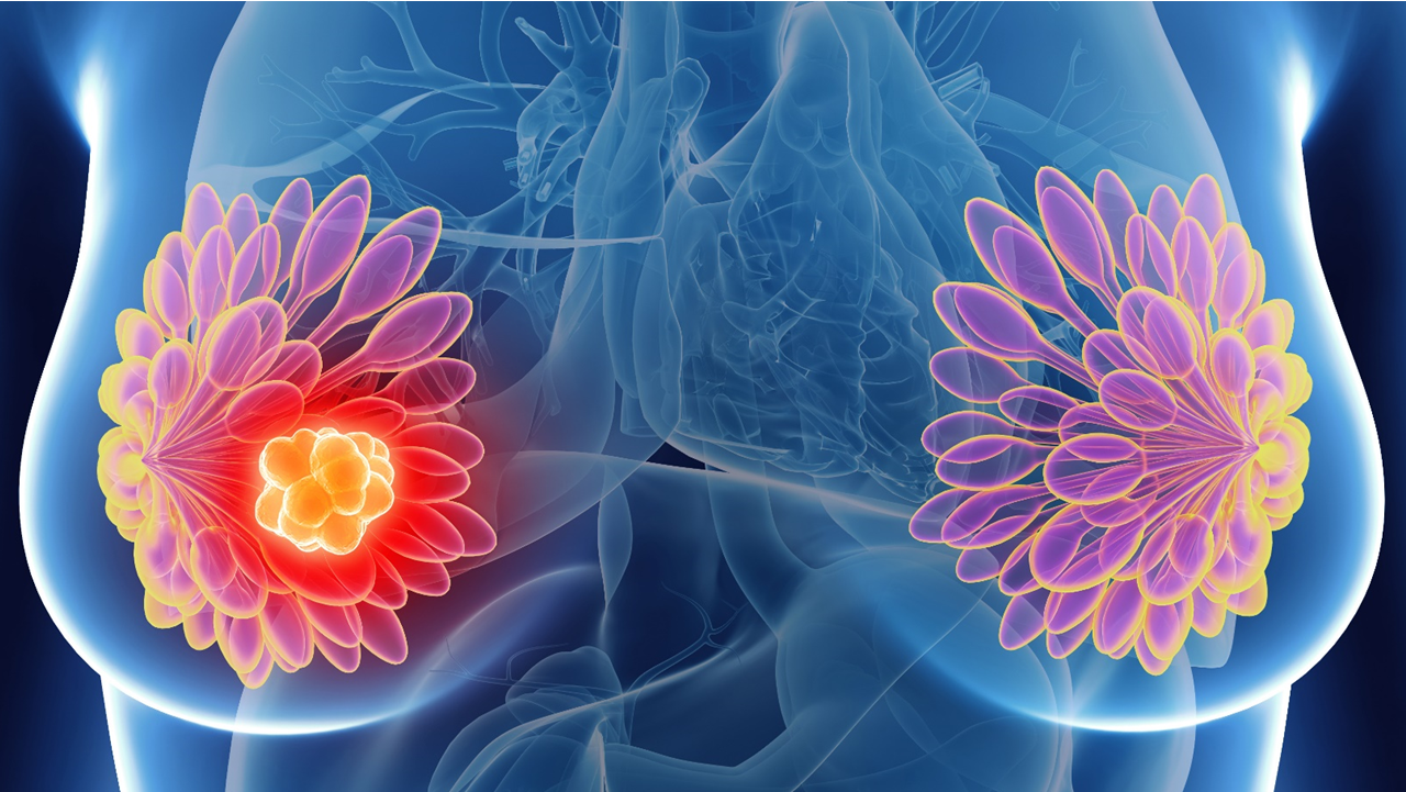 La FDA aprueba Dato-DXd para cá. de mama RH+/HER2– metastásico, estudio TROPION-Breast01