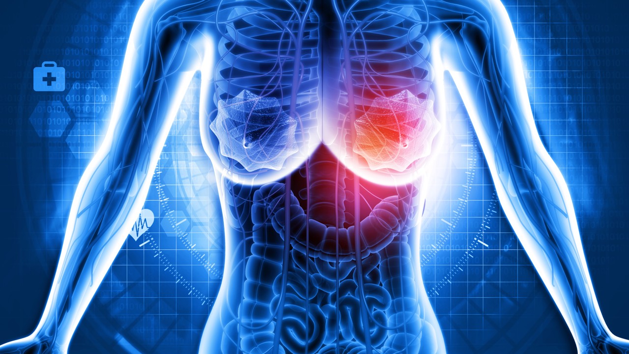 Cáncer de mama HER2-positivo: T-DM1 mejora la supervivencia en pacientes con enfermedad invasiva residual tras la terapia neoadyuvante, estudio KATHERINE