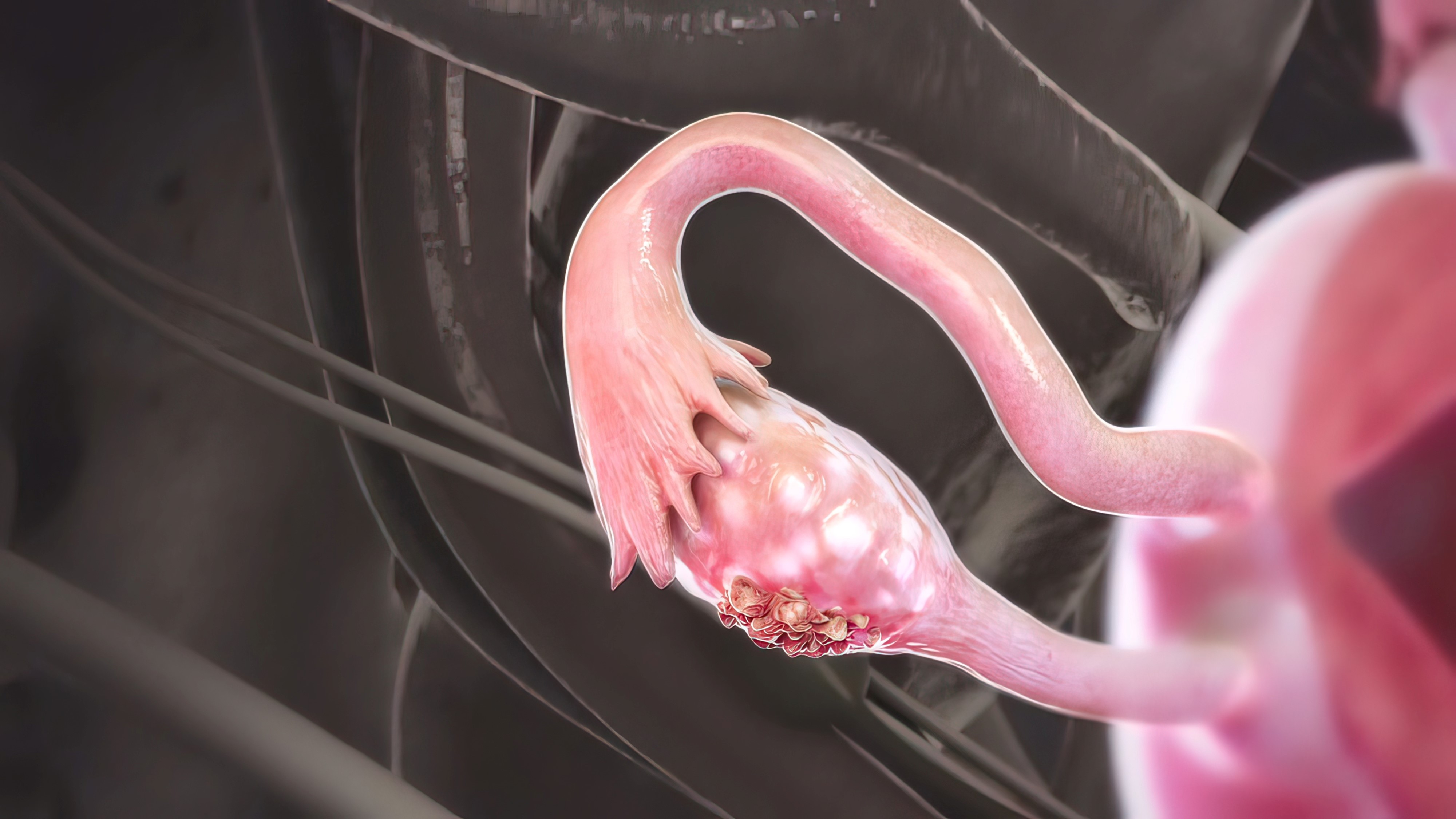 Cáncer de ovario resistente al platino: la combinación de relacorilant y nab-paclitaxel mejoran la SLP y la SG, estudio ROSELLA