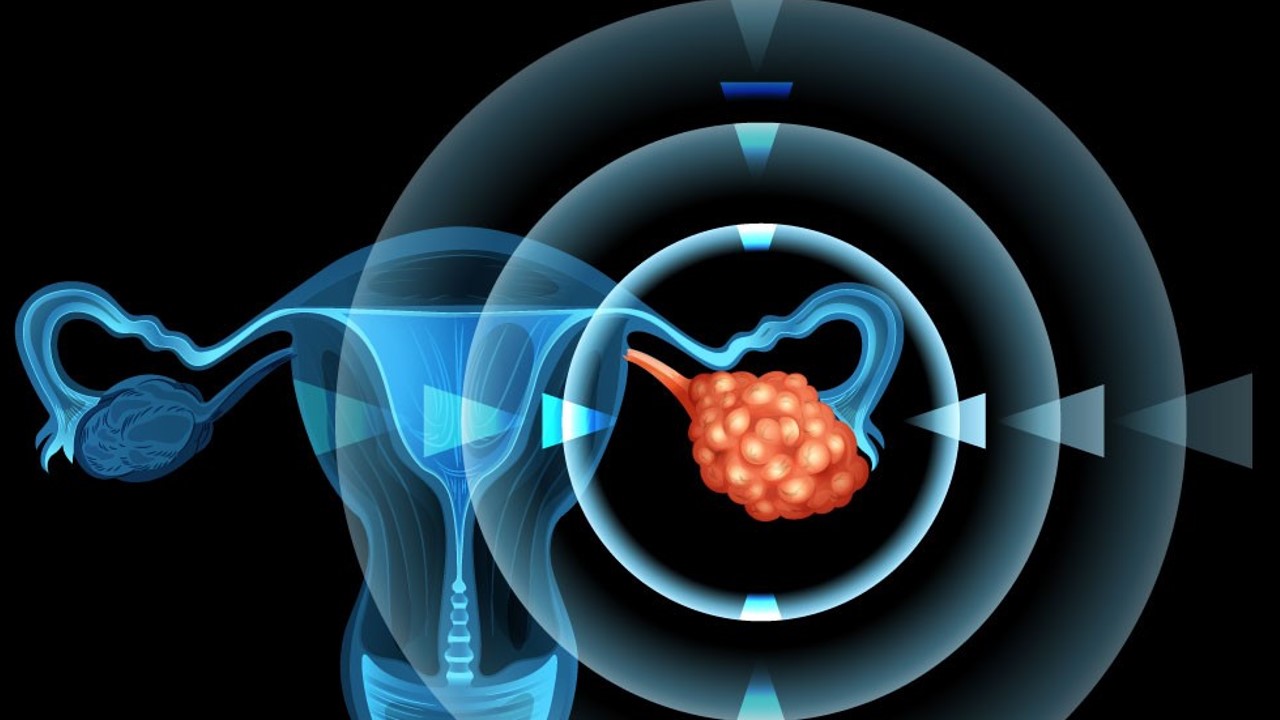 Cá. de ovario resistente a platino: Mirvetuximab soravtansina muestra beneficio en SG, estudio MIRASOL