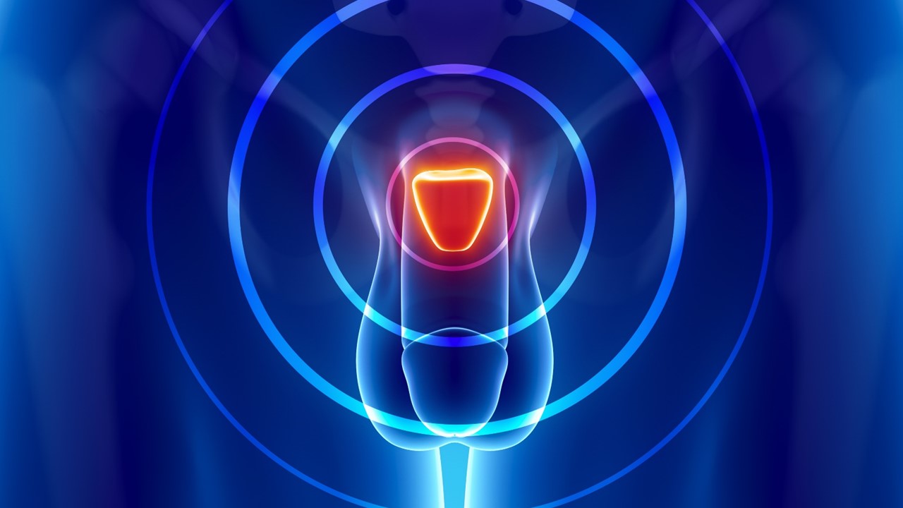 CPRCm: la combinación de pembrolizumab + docetaxel no mostró mejora en la supervivencia, estudio KEYNOTE-921