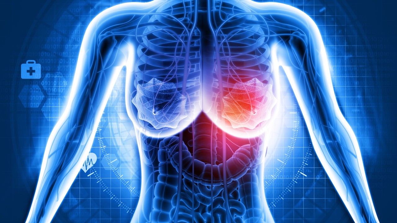CMm HER2-positivo: trastuzumab deruxtecán más pertuzumab demuestran beneficio en SLP en primera línea, estudio DESTINY-Breast09