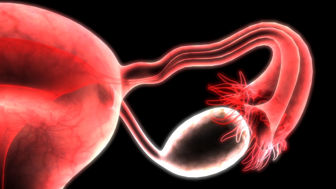 Cáncer de ovario seroso de bajo grado recurrente KRAS mutado: FDA otorga aprobación acelerada a avutometinib + defactinib