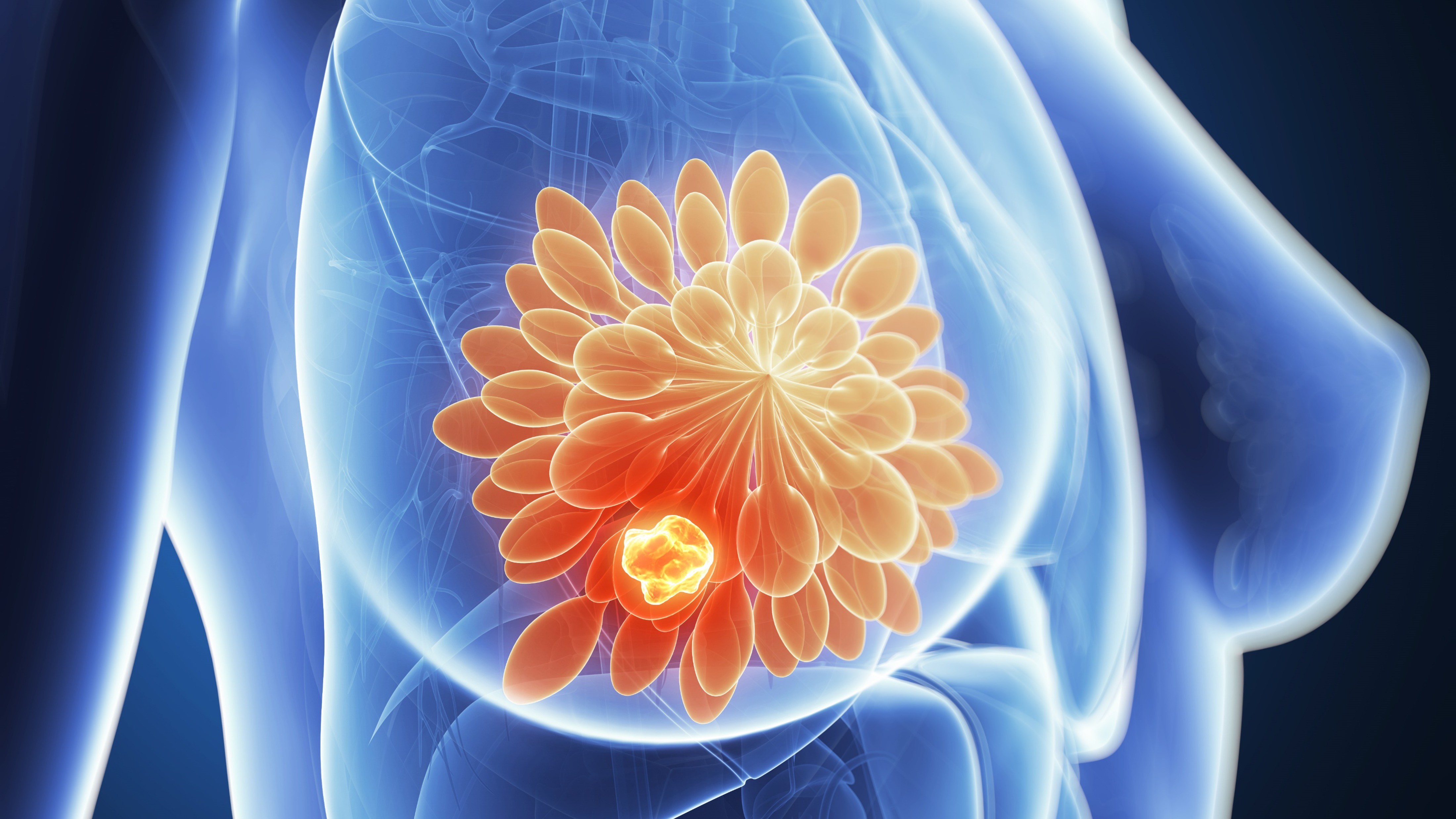 Cáncer de mama avanzado con mutación PIK3CA: inavolisib, palbociclib y fulvestrant mejoraron significativamente la SG, estudio INAVO120