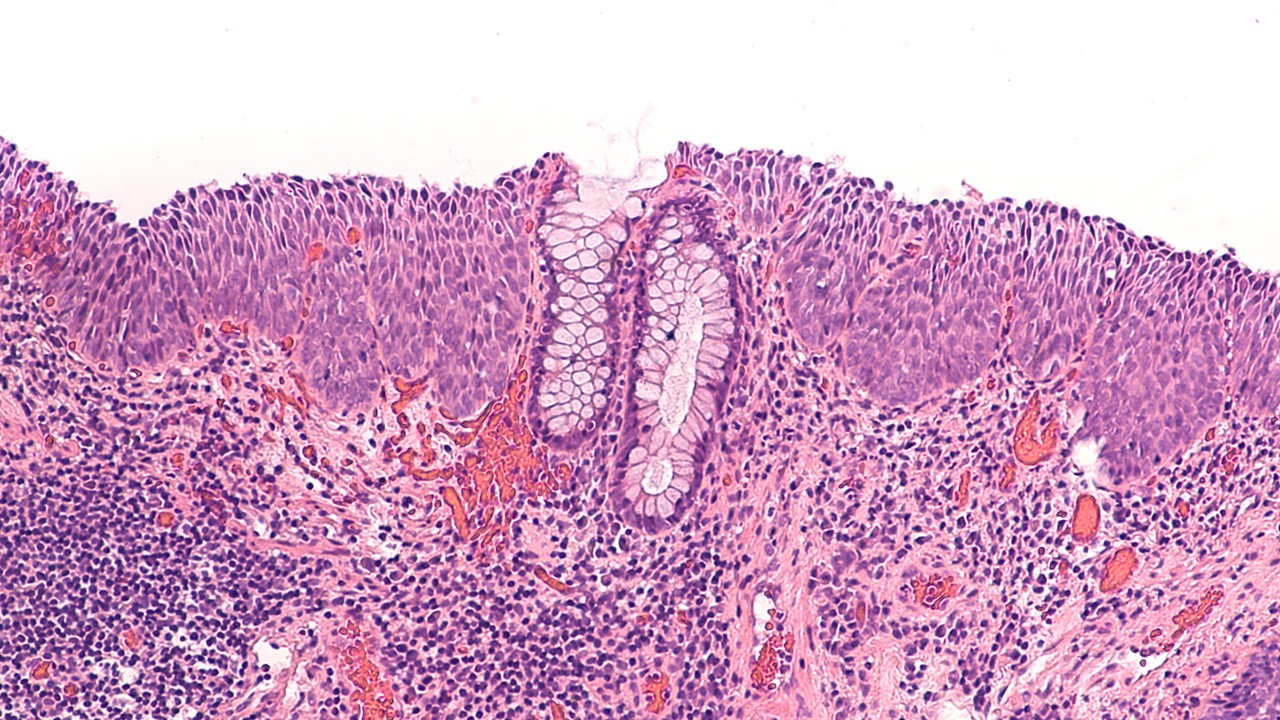 Carcinoma de células escamosas del canal anal localmente recurrente, inoperable o metastásico: FDA aprueba retifanlimab solo o con QT