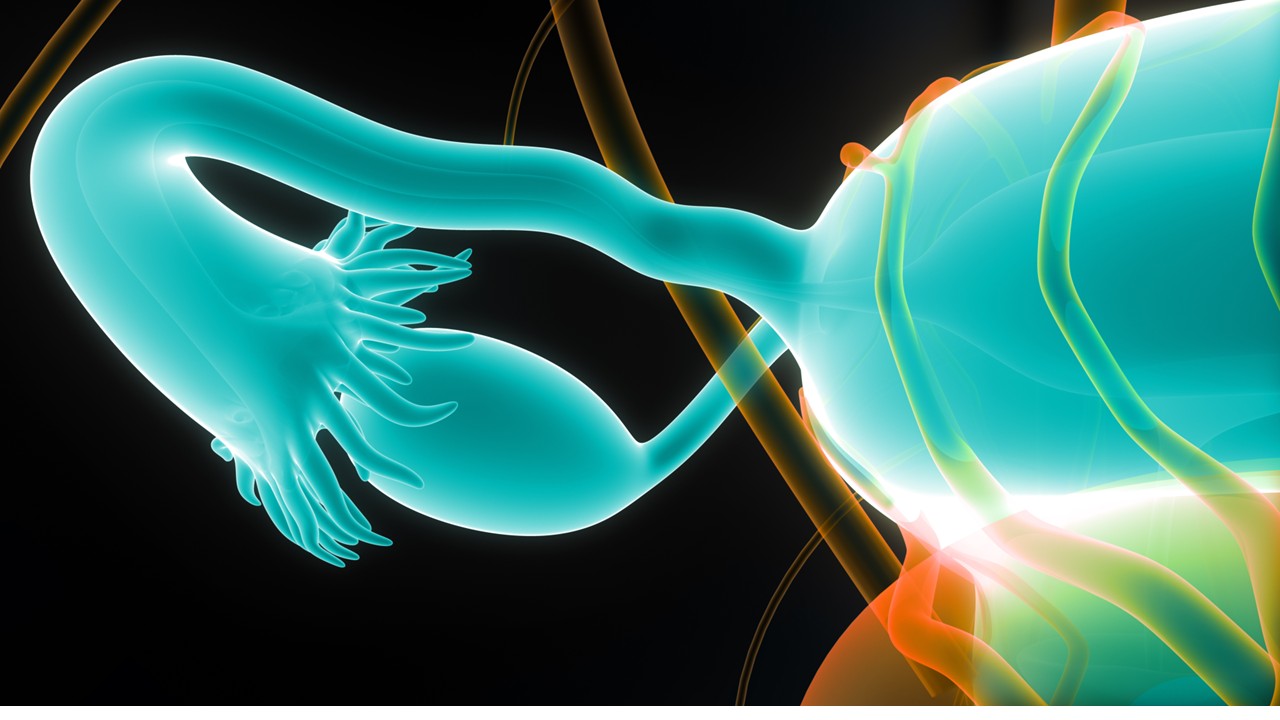 Cá. de ovario recurrente resistente al platino: la combinación de pembrolizumab con paclitaxel, alcanzó su objetivo principal de SLP, estudio KEYNOTE-B96