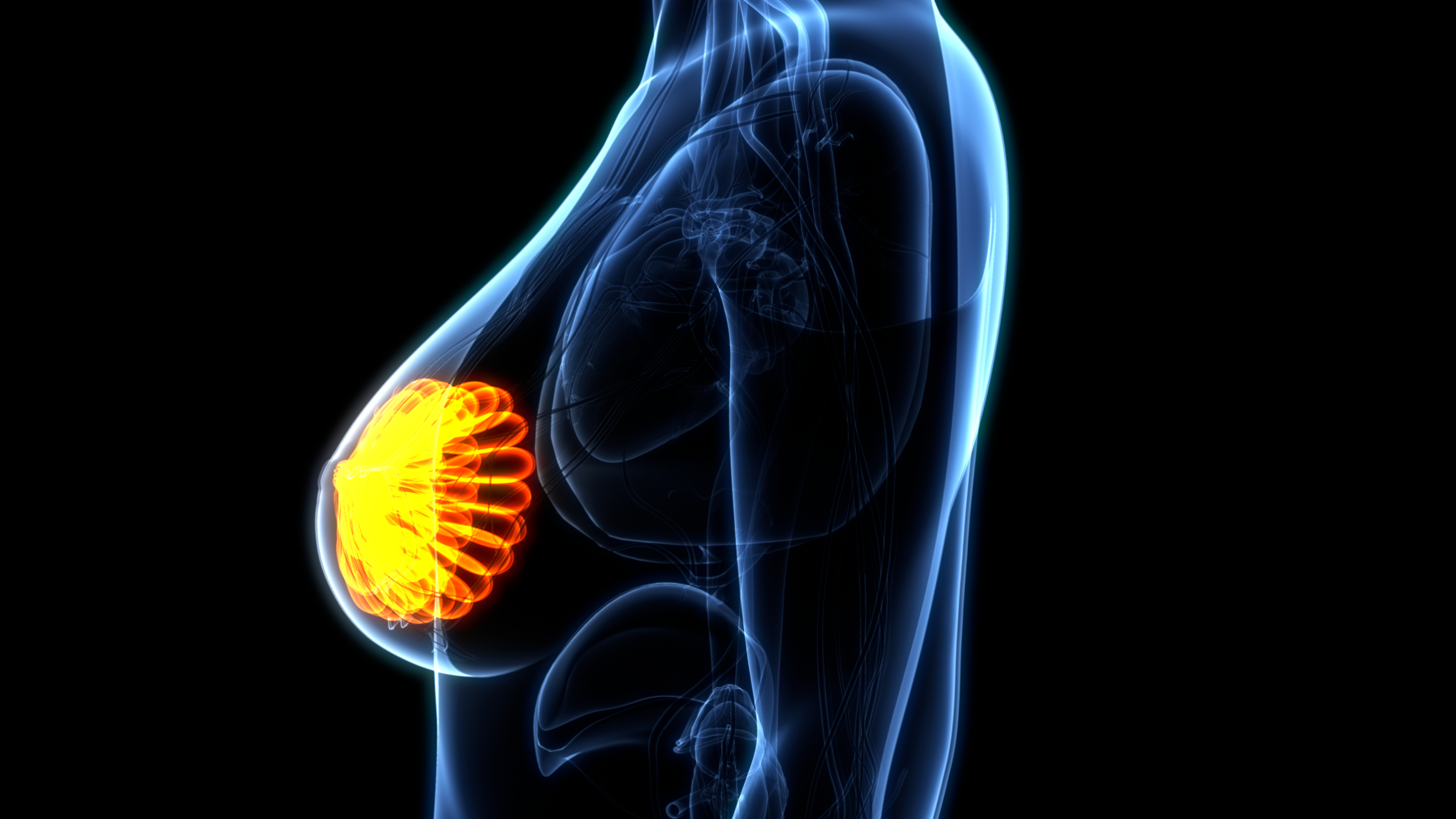 Cá. de mama temprano HER2-positivo: estudio APHINITY confirma beneficio en SG a 10 años adicionando pertuzumab a trastuzumab y QT