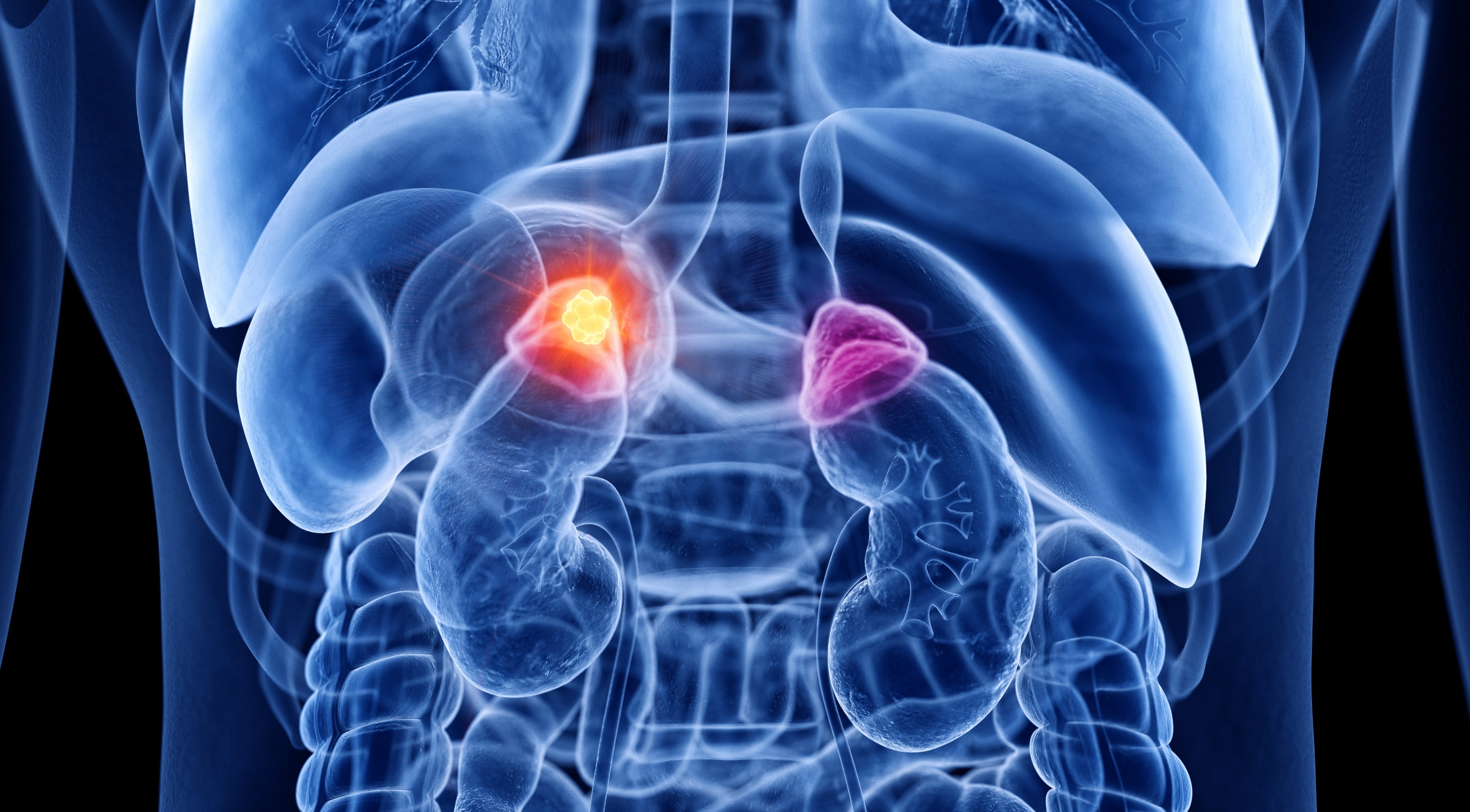 Feocromocitoma o paraganglioma localmente avanzado, irresecable o metastásico: FDA aprueba belzutifán en pacientes adultos o pediátricos