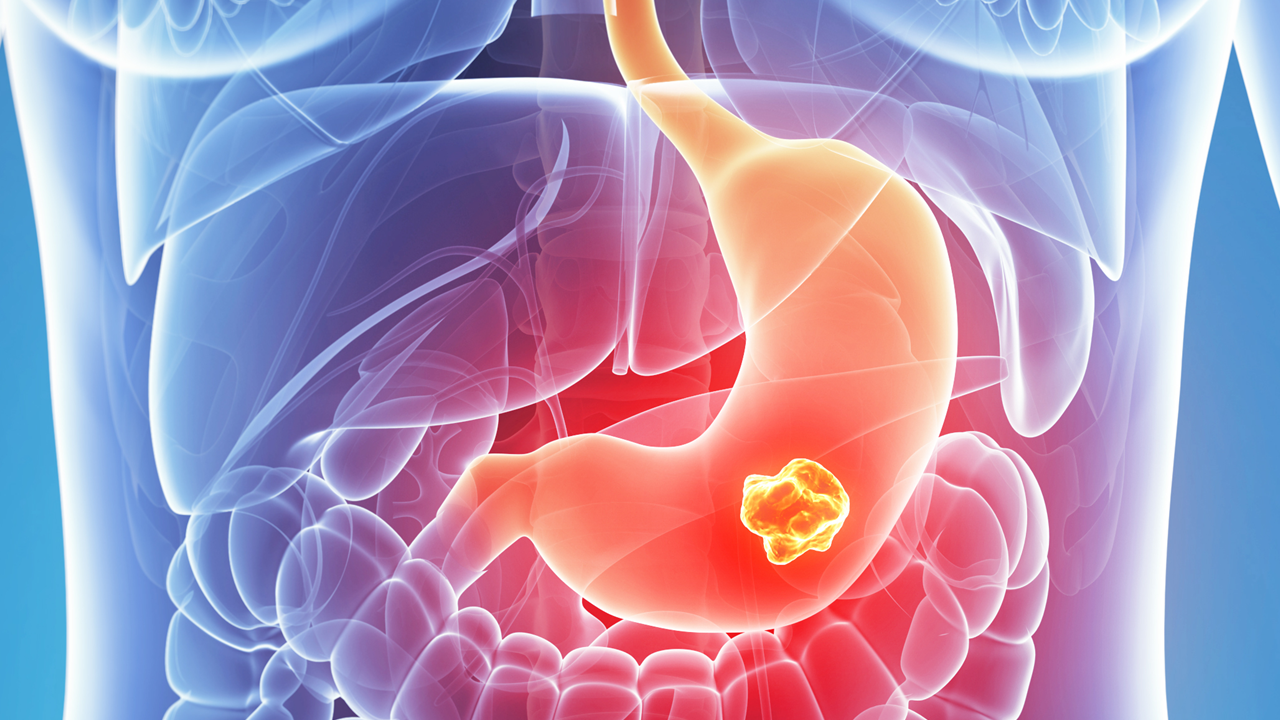 Cáncer gástrico: bemarituzumab mejora SG y SLP en enfermedad avanzada FGFR2b positiva, estudio FORTITUDE-101