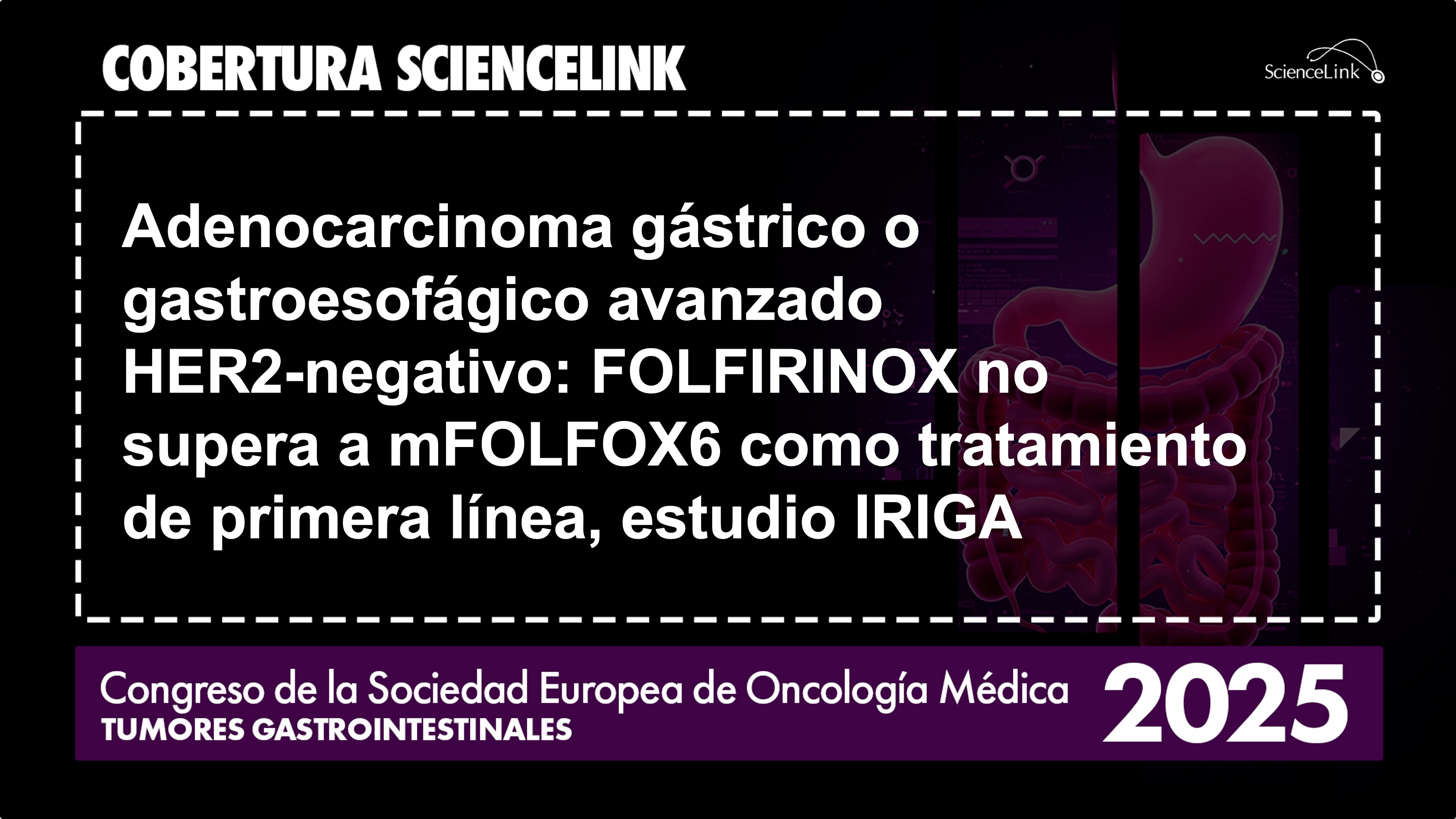 Adenocarcinoma gástrico o gastroesofágico avanzado HER2-negativo: FOLFIRINOX no supera a mFOLFOX6 como tratamiento de primera línea, estudio IRIGA
