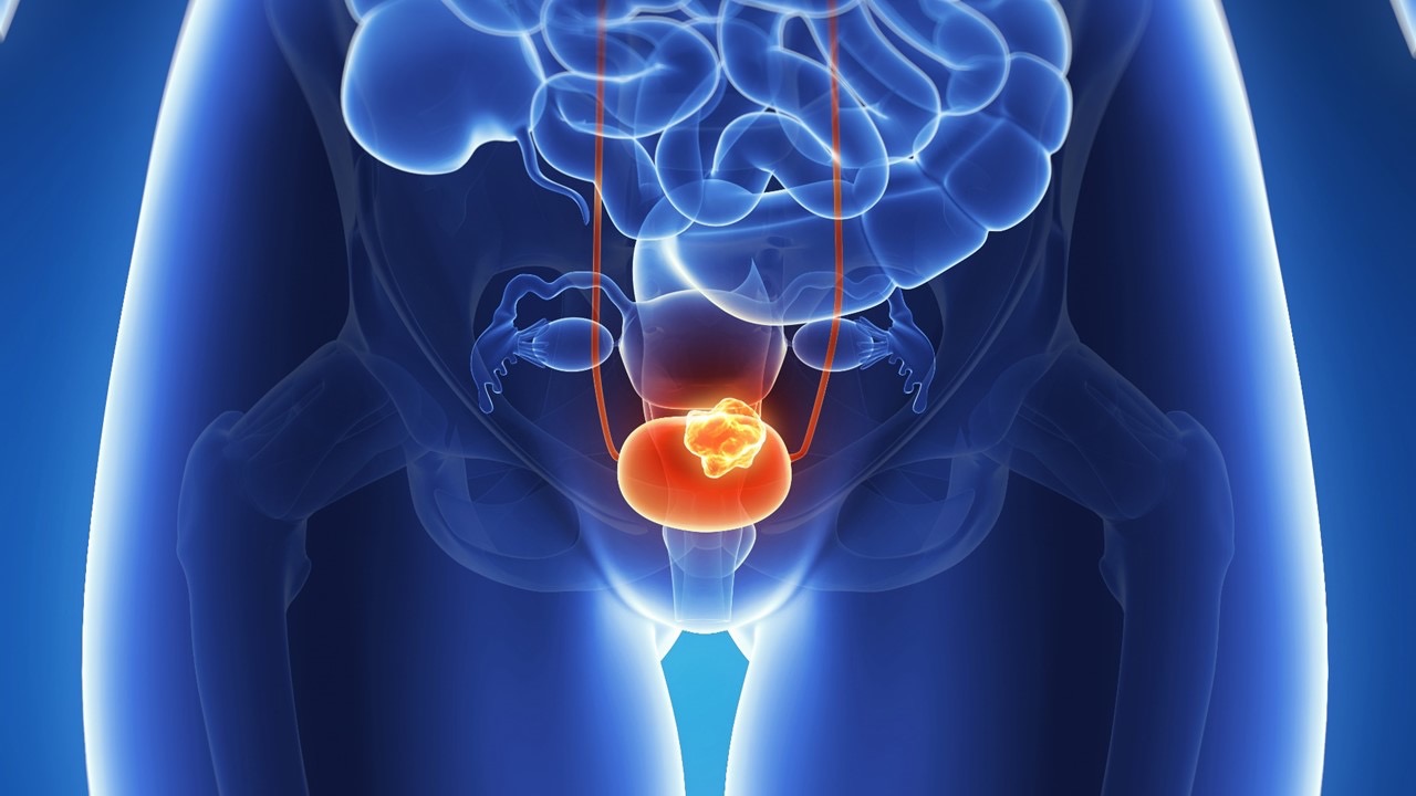Cáncer de vejiga músculo-invasor: aprobación europea de durvalumab en esquema perioperatorio