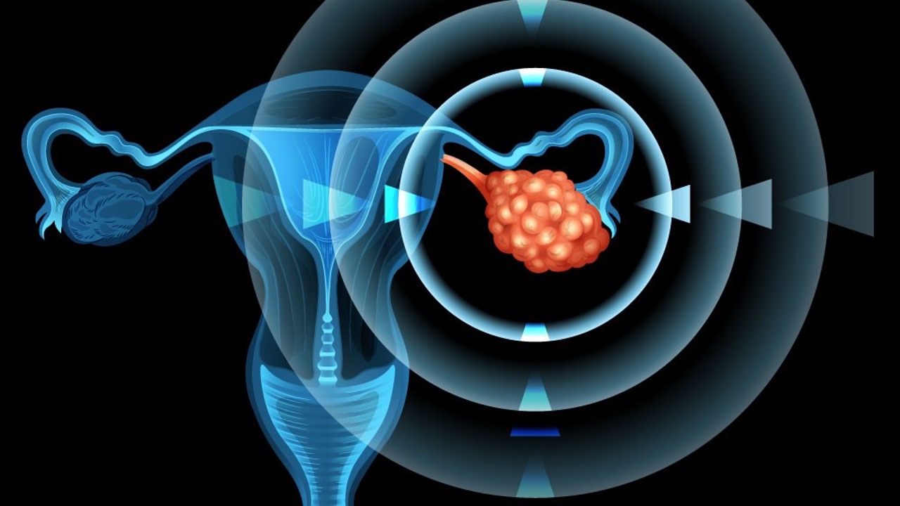 Cáncer de ovario: test Geneva HRD predice beneficio en supervivencia con olaparib y bevacizumab