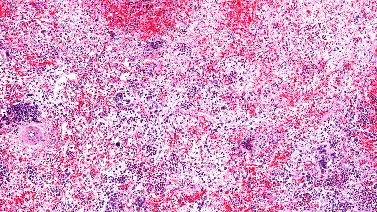 Luspatercept mejora parámetros hematológicos en anemia asociada a mielofibrosis pese a no alcanzar objetivo primario en estudio INDEPENDENCE